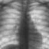 У Полтаві на 25% зменшилася кількість смертей від туберкульозу
